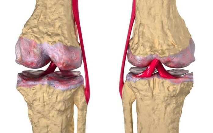 Osteoartrite da articulação do joelho