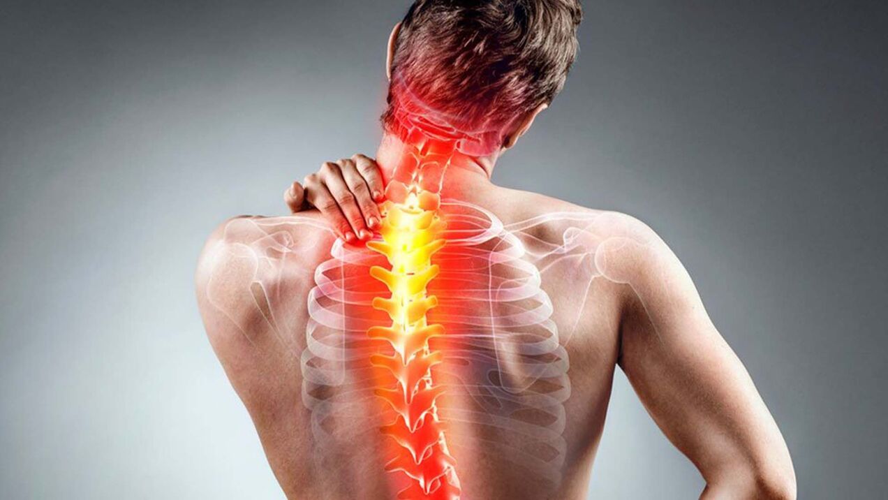 sintomas de osteocondrose espinhal